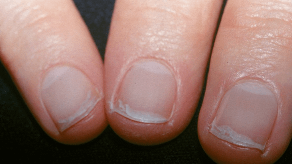 Damaged Nails